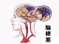 養(yǎng)成好的生活習(xí)慣，能夠有效預(yù)防腦梗塞